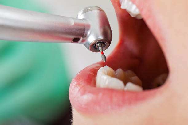 Best Broken or Chipped Tooth Repair in Malden, MO